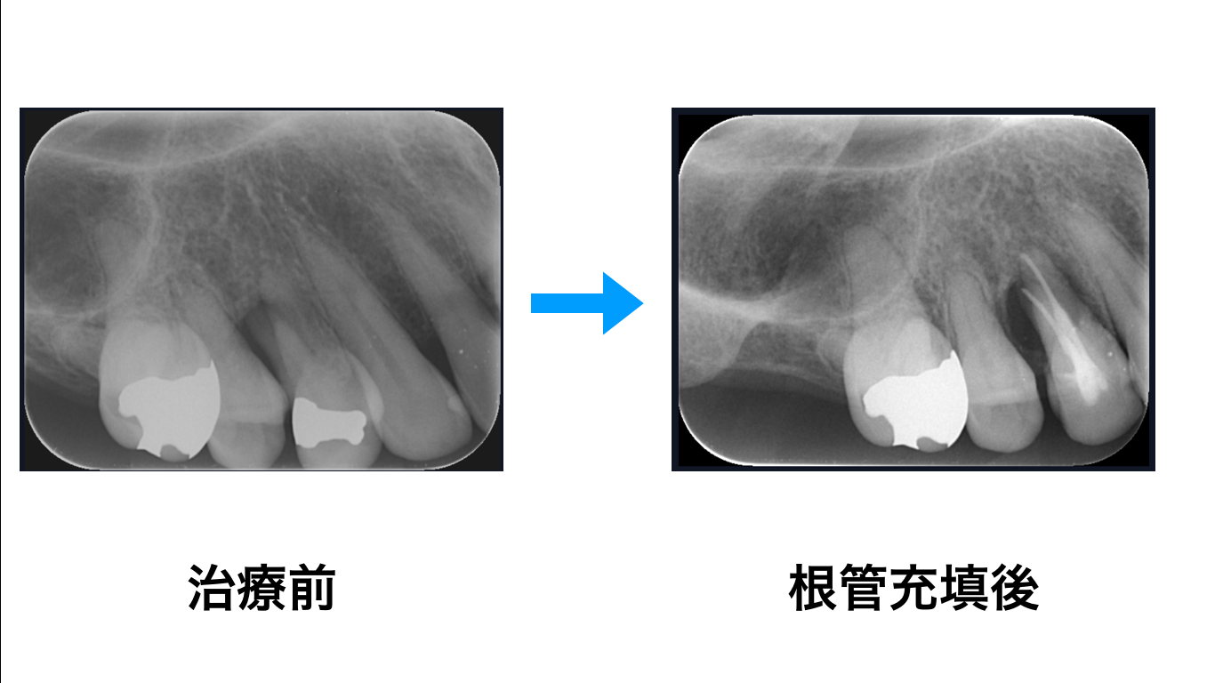 歯を残す治療 ｜﻿にじいろマイクロスコープセラミック歯科医院｜大泉 